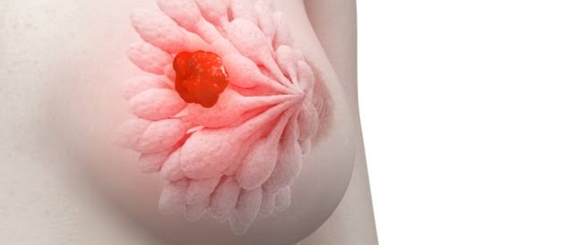 تفاصيل سرطان الثدي عند النساء