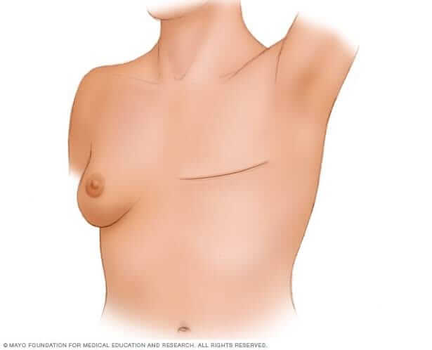 انواع علاج سرطان الثدي طرق فحص سرطان الثدي في المنزل  