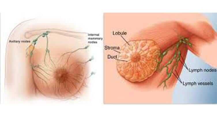 3 انواع علاج سرطان الثدي:أعراض سرطان الثدي الخبيث وأعراض سرطان الثدي الحميد: