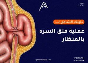 افضل دكتور جراحة عامة في القاهرة |علاج الفتق السري بالمنظار
