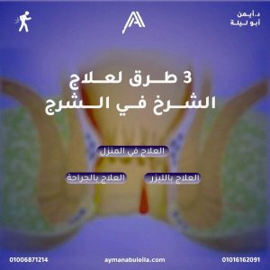 Read more about the article 3 طرق لعلاج الشرخ في الشرج: علاج الشرخ الشرجي بجراحة وبالليزر