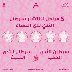 5 مراحل انتشار سرطان الثدي|وماهو سرطان الثدي الخبيث والحميد
