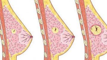سرطان الثدي عند النساء :مكان ورم او كتلة سرطان الثدي: