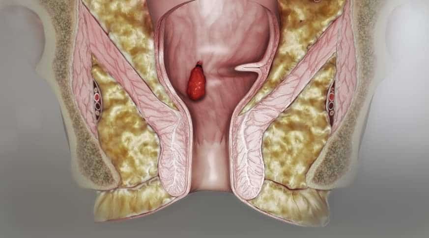 You are currently viewing 6 اعراض البواسير الداخلية عند الرجال|واسباب وجود البواسير الداخلية