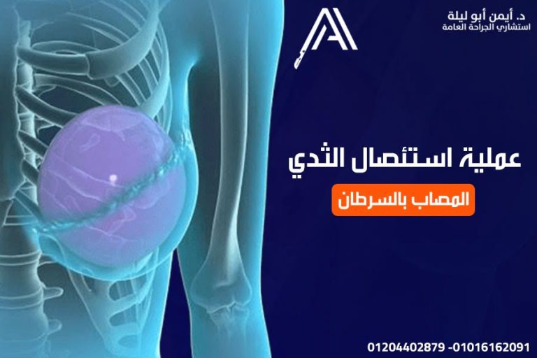 افضل دكتور جراحة عامة في القاهرة لعملية استئصال الثدي المصاب بالسرطان